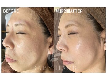 フィズ 府中店(FIS)/☆ハーブピーリング☆都度払い 