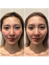 ケイビューティーサロン(K BeautySalon)/当店のコルギ