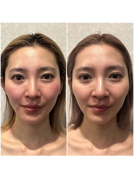 ケイビューティーサロン(K BeautySalon)/当店のコルギ