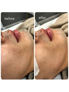 ナチュラル シャイン(NATURAL SHINE)/ヒゲ脱毛