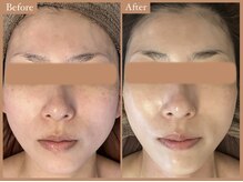 リムーン 岡崎(Re'moon)/REVI ハーブピーリング