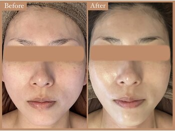 リムーン 岡崎(Re'moon)/REVI ハーブピーリング