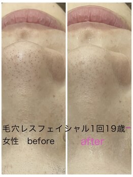 フォルチェ 神辺店(Folche)/毛穴レスフェイシャル