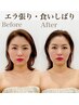 【小顔矯正】長年の食いしばりからくる エラ張りでお悩みの方　初回体験