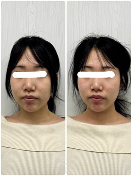 ラフテル鍼灸整骨院/美容鍼は学割クーポンもご用意♪