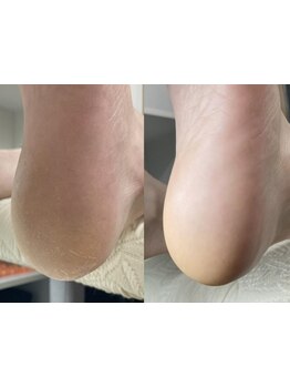 角質ケアができるサロン