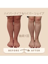 コリ チル(Kori Chill)/【ハイパーナイフ＆シェイプ】