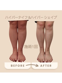 コリ チル(Kori Chill)/【ハイパーナイフ＆シェイプ】