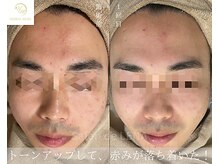 サロンドレナ 名駅店/ハーブピーリング サロンドレナ