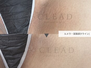 クリード(CLEAD)/ルメラ鼠蹊部/¥75000クリーム付