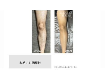 サロン ルアナ(salon luana)/メンズ脚脱毛　before→after
