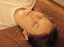 アクア鍼灸整骨院 錦糸町院の雰囲気（美容鍼も人気メニューです♪）