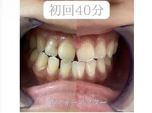 ホワイトニングショップ 亀岡店/【初回ビフォーアフター】美白