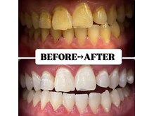ホワイトニングサロン 豊中/Before&After美白ホワイトニング