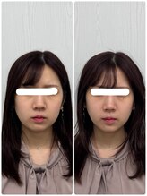 ラフテル鍼灸整骨院/ブライダル前に小顔矯正を！