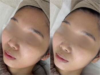 アンリミット 原宿竹下通り店(Une limit)/【赤みケア】