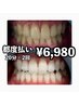 【どなたでも利用可！】美白ホワイトニング20分×2回　￥6980