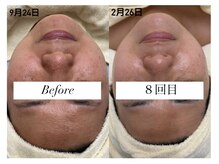 クレア(Claire)の雰囲気（ハーブor乳酸菌ピールを肌状態に合わせながら８回の変化！）