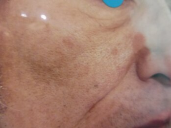 エムズ(M’s)/しみケア施術後