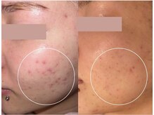 リファラ 光の森店(REFALA)/毛穴・ニキビケア専門REFALA