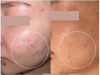 リファラ 光の森店(REFALA)/毛穴・ニキビケア専門REFALA