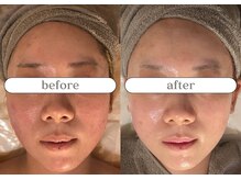 リスタ(RSTA)/【BEFORE/AFTER】