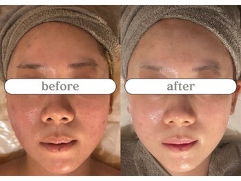 リスタ(RSTA)/【BEFORE/AFTER】