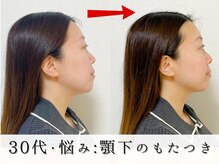 ジョンミー(JONMEE)/顎下のもたつきに小顔矯正