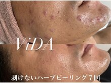 ヴィーダ 渋谷松濤(ViDA)/お肌を育てるハーブピーリング