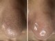 サラグランデ(Sara Grande)の写真/【話題の毛穴エクストラクション♪】毛穴の黒ずみ、ざらつきオフ！新生活は綺麗な毛穴でスタート♪男性も◎