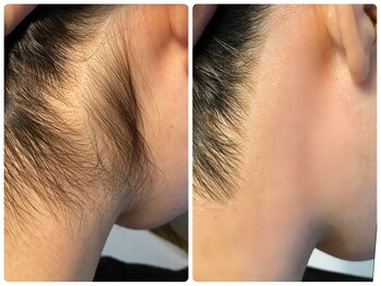 アロー(Allo!)/うなじWAX脱毛