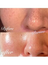 プルネ(Purune)/ハイドラフェイシャル*毛穴洗浄