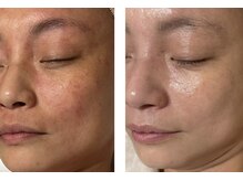 アドビューティ(Add Beauty)/≪プラズマフェイシャル≫