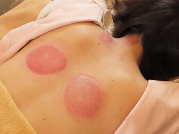 初田鍼院 恵比寿/個人差はありますが、カップ跡は