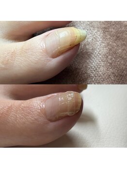 巻き爪矯正1回目(左親指)