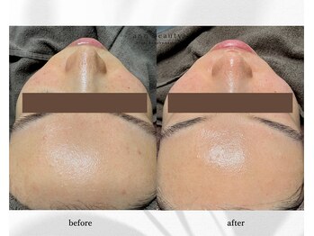 アン ビューティー(ann beauty)/施術3回【症例写真】20代