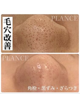 プランス 博多店(PLANCE)/博多 エステ 毛穴ケア