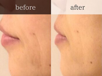 ティアラ/ハーブピーリング