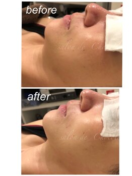 サロンドショコラ(salon de chocolat)/美白?フェイスライン?