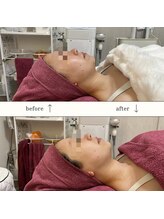 GRACETHOUSAND(グレイスサウザンド)/【肌質改善◎】ハーブピーリング