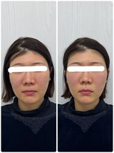 ラフテル鍼灸整骨院/眼精疲労改善に美容鍼が◎