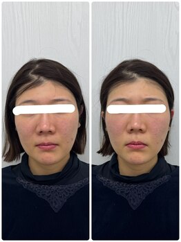 ラフテル鍼灸整骨院/眼精疲労改善に美容鍼が◎