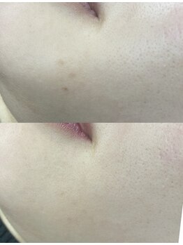 ラ ブリエ(La Briller)/プラズマ照射とシミケア徹底