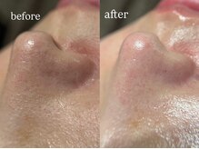 ビビ(Vivi)/毛穴洗浄