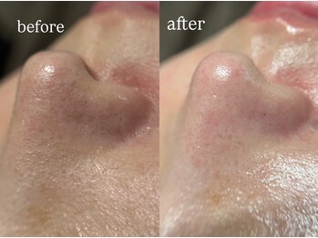 ビビ(Vivi)/毛穴洗浄