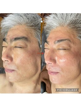 リリーローズ(LilyRose)/ハイパーナイフフェイシャル