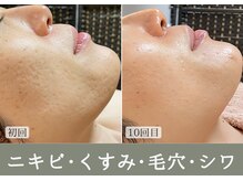 綺華(Ayaka)の雰囲気（＼植物ハーブピーリング ／毛穴・くすみ・シワニキビのケアに♪）