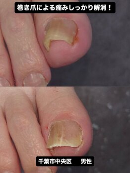 巻き爪じゅん 千葉駅前店/巻き爪と痛みを徹底改善