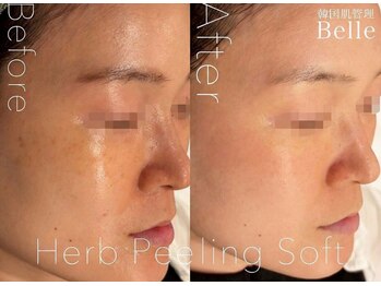 ベル 代々木店(Belle)/#毛穴#ニキビケア#代々木#新宿