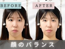 エルシンメトリー矯正院(ailesシンメトリー矯正院)/３回目before＆after小顔矯正